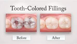 Tooth Colored Filling